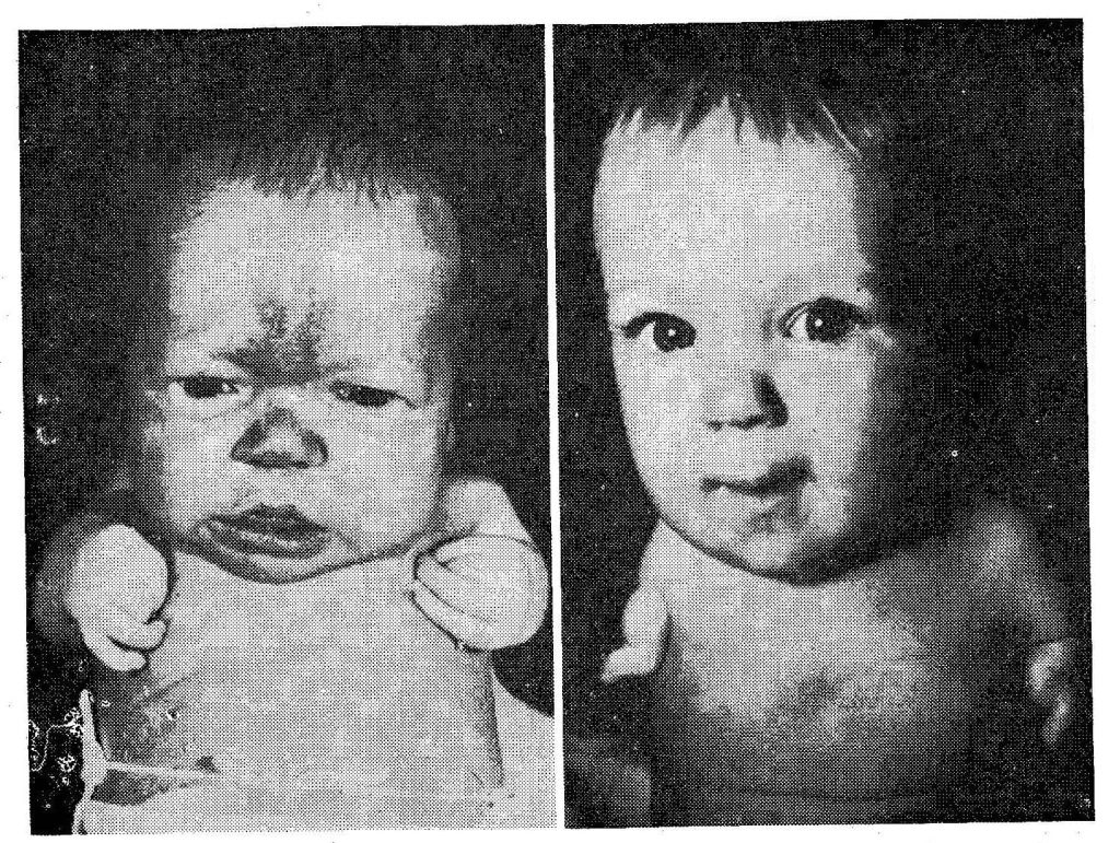 Talidomid (1957): cudowna pigułka, która okaleczyła pokolenie
